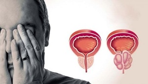 prostatitisaren arrazoiak gizonezkoetan