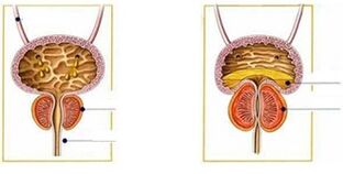 prostatitis motak eta formak gizonezkoetan
