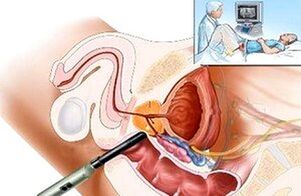prostatitisa diagnostikatzeko moduak