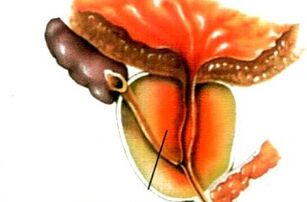 zer da prostatitisa gizonengan