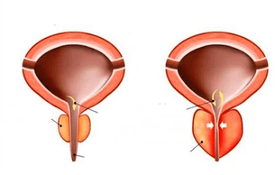 zer da prostatitis akutua