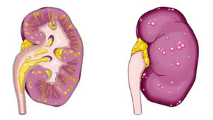 zerk eragiten duen prostatitis akutua