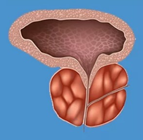 Sintoma tipikoak prostatitis