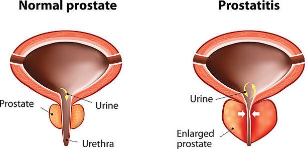 prostata normala eta hanturatua