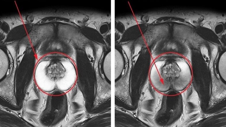 prostatitis kronikoa duen prostata osasuntsu eta hanturatua