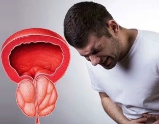 Sintomak kronikoa prostatitis gizon