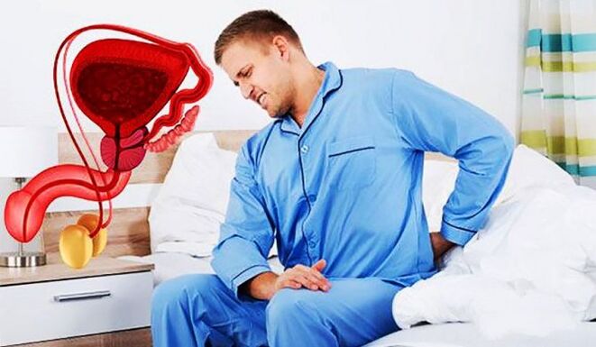 bizkarreko mina prostatitisaren ondorioz