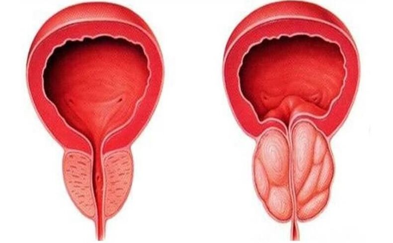 prostatitisarekin prostata osasuntsu eta hanturatuta